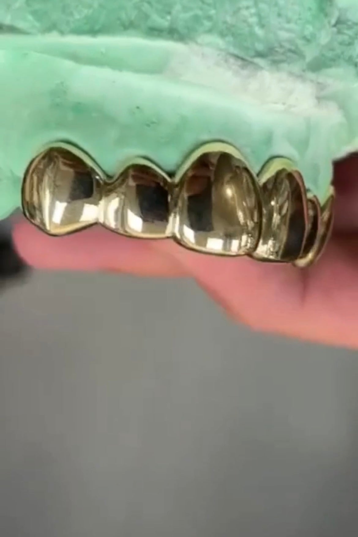 6x Dental Gold