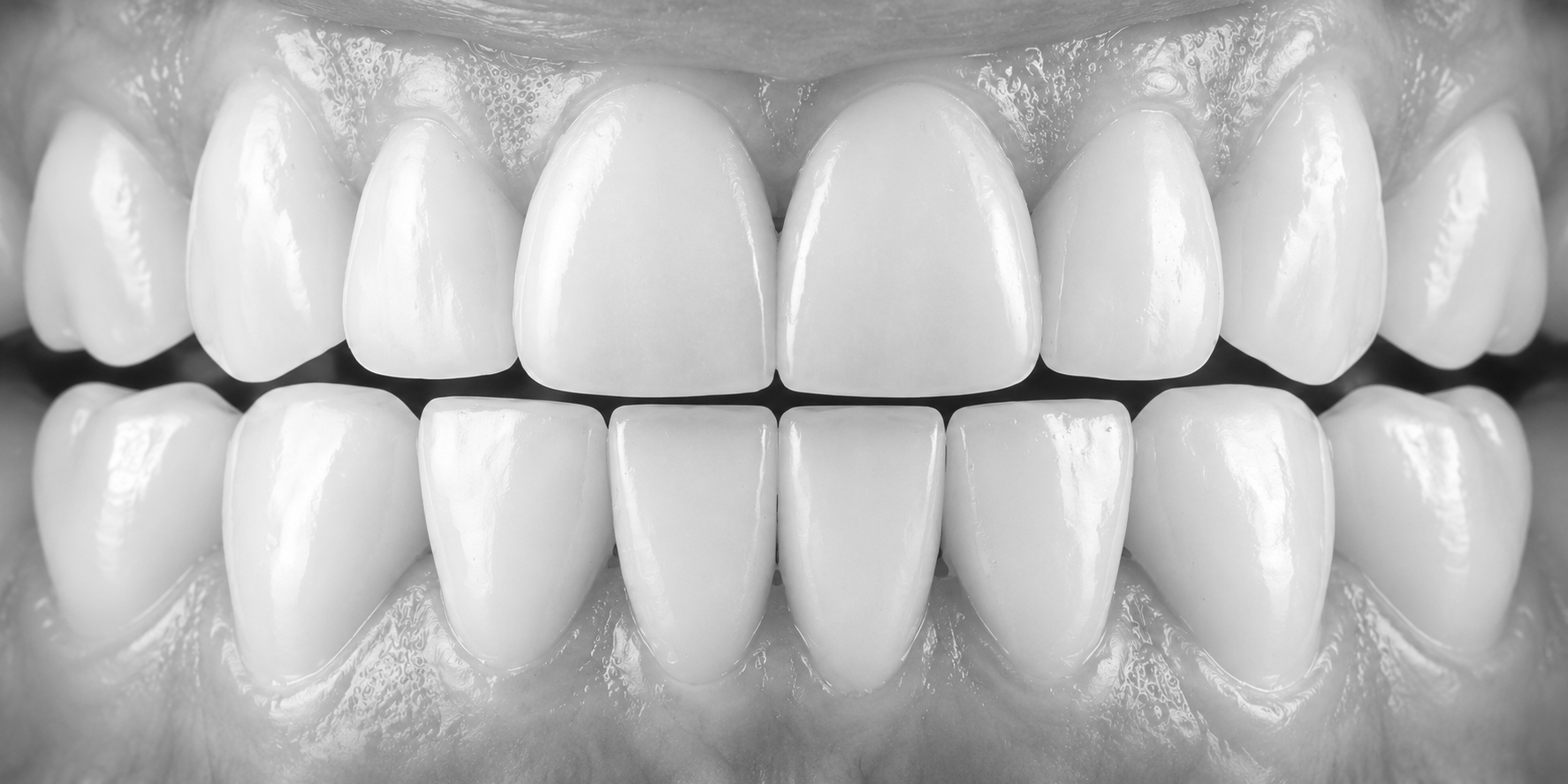 Photographic dental cast showing individual, precisely aligned grillz